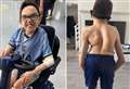 Birthday fundraiser for ‘ray of sunshine’ teen with rare ‘organ crushing’ spinal condition