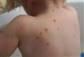 Chickenpox vaccine: Why do experts now think it’s time to offer it on the NHS?