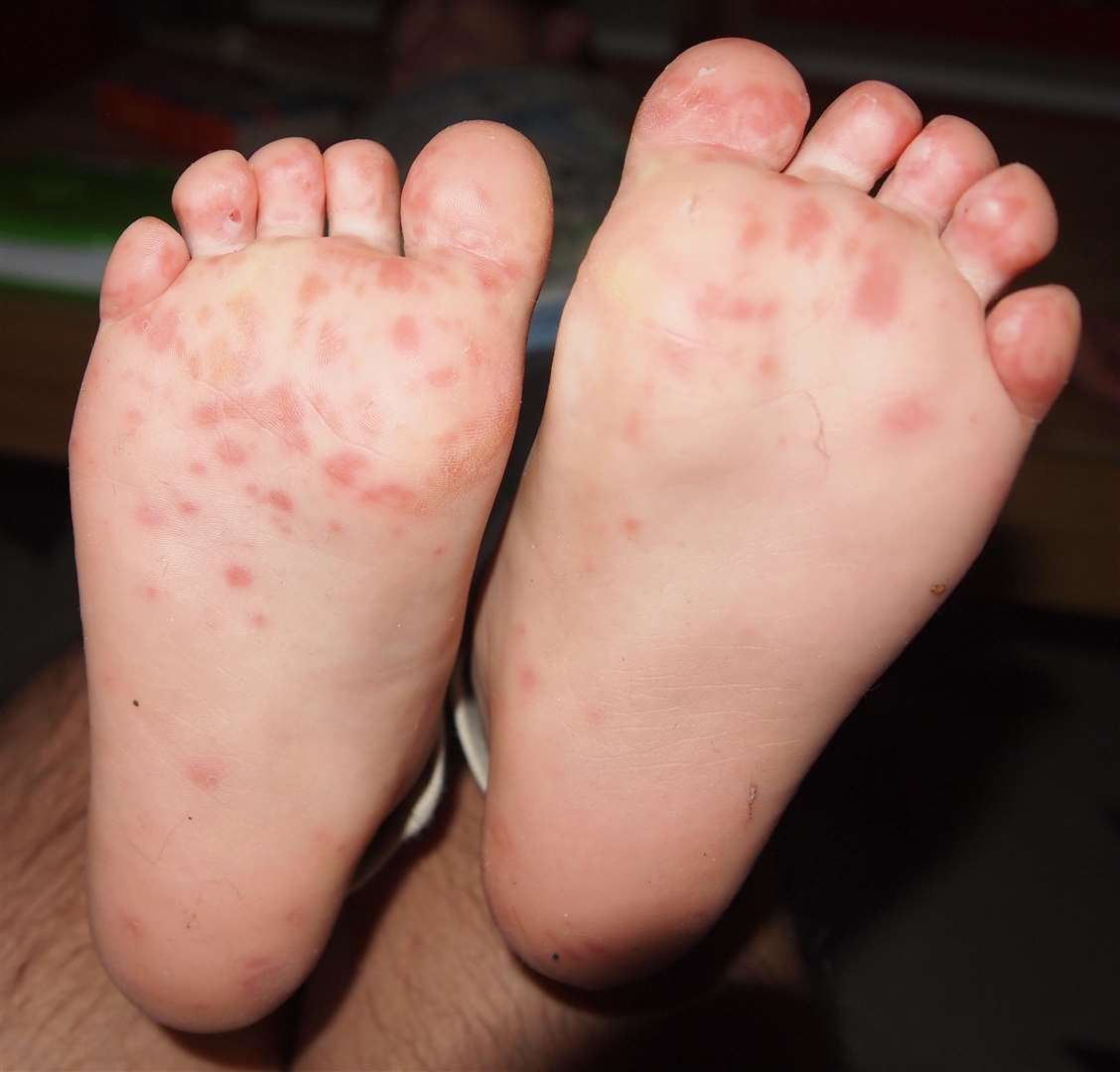 Hand, foot and mouth can cause a rash on a child's feet.