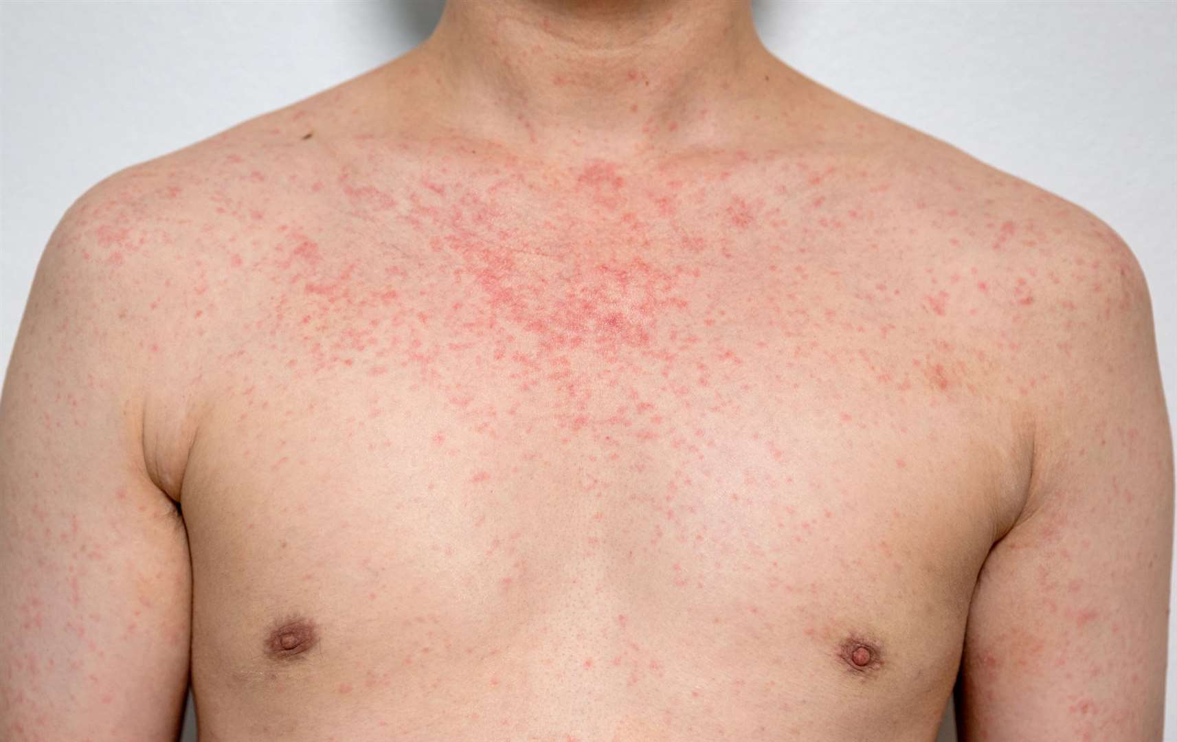 Measles cases in England are continuing to rise. Image: iStock.
