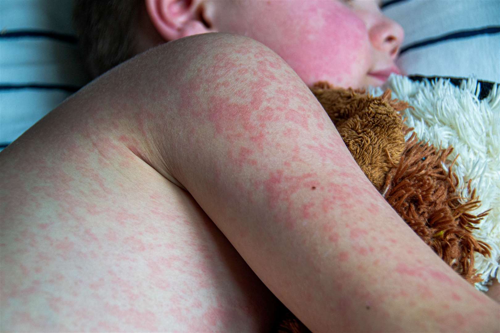 Measles is highly contragious because it is spread through coughs and sneezes. Picture: Stock photo