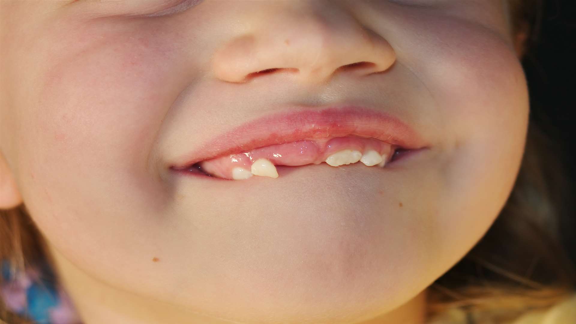 A child's baby teeth begin to loosen and fall out to make room for permanent teeth at about age six