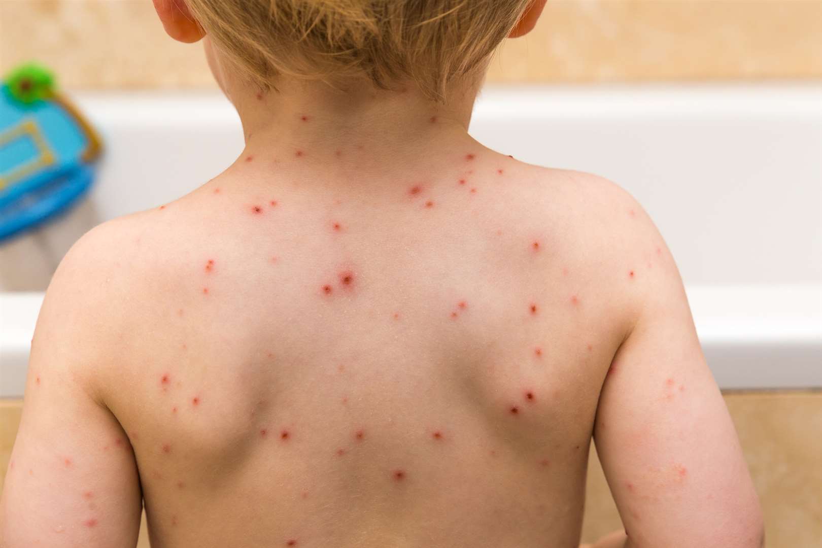 Most children will catch chickenpox at some point